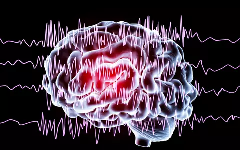 (P) EEG diagnostichează corect epilepsia prin metode moderne