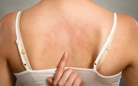 Studiu: 5 afecțiuni ale pielii care pot semnala existenţa infecției COVID-19. Ce simptome ar trebui să te trimită de urgență la medic
