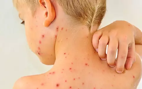 România se confruntă cu încă o epidemie: 20.000 de bolnavi și 64 de morţi, din cauza rujeolei (pojarului)