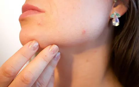 Alimentele care pot provoca acnee și riduri. Evită-le dacă observi că apar probleme imediat ce le consumi, deși este grea viața fără ele!