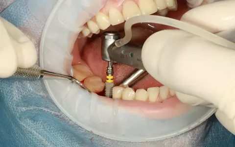 (P) Ce trebuie să știi despre implantul dentar