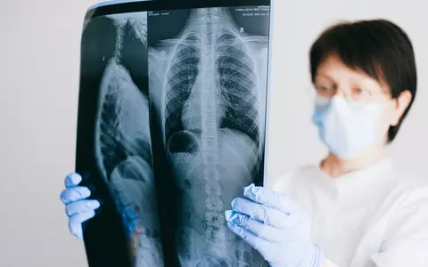 (P) Fracturile vertebrale - cât de periculoase sunt și cum pot fi tratate?