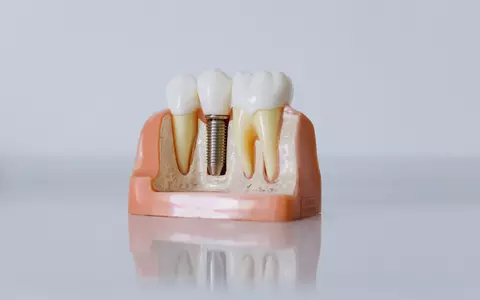 Sfaturi pentru o alimentație corectă după un implant dentar