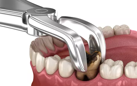 Ce trebuie să știi despre extracțiile dentare
