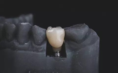 Descoperă toate informațiile de care ai nevoie în vederea tratamentului cu implant dentar
