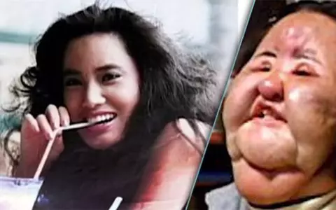 O femeie din Coreea de Sud și-a distrus fața după ce și-a injectat ulei de gătit. Cum a ajuns să arate, acum