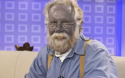 Povestea lui Papa Ștumpf, americanul căruia i s-a făcut pielea albastră, după un tratament pentru dermatită. Cum i s-a schimbat viața și de ce a murit