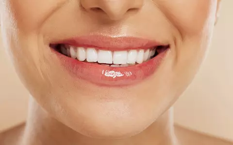 Beneficiile estetice ale fațetelor dentare