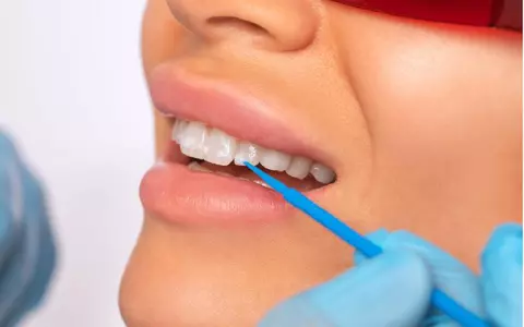 Cum îți dai seama dacă dinții tăi s-au demineralizat și ce poți face in acest caz?