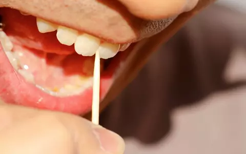 De ce nu este bine să folosești scobitori ca să cureți spațiile dintre dinți