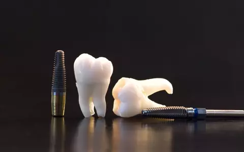 Avantajele și beneficiile tratamentului cu implant dentar