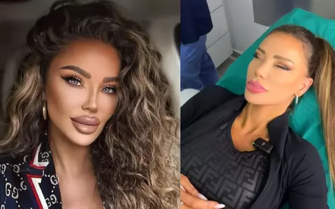 Bianca Drăgușanu își face lifting facial: "Fața mea a fost stricată de forma buzelor, pe care le-am injectat de peste 20 de ani, mult și prost"