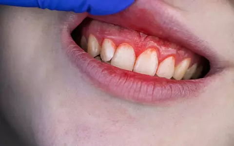 Sângerarea Gingivală - Pericol Pentru Sănătatea Orală