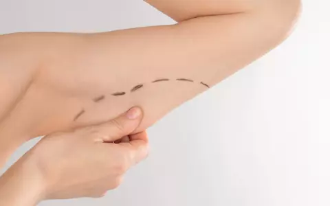 3 situații când soluția este un lifting brațe profesionist