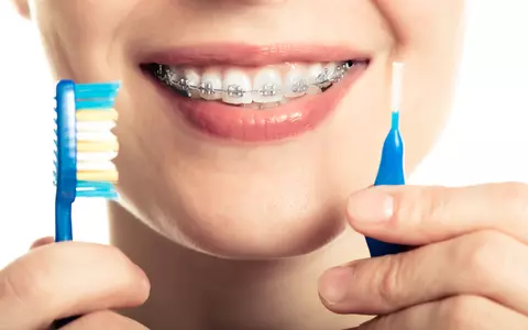 Patru sfaturi practice pentru îmbunătățirea igienei orale atunci când porți aparat dentar fix