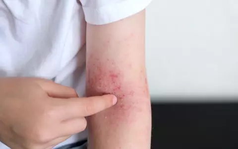 Cine poate fi cel mai afectat de dermatita atopică?