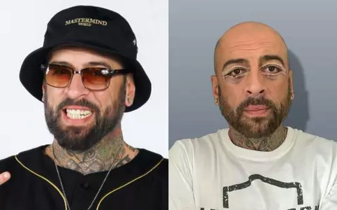 Cum arată CRBL după ce și-a făcut prima operație estetică la față: „Mă simt foarte bine și sunt mândru că am depășit prejudecățile”