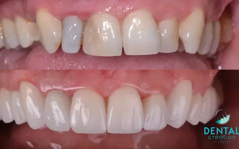 Faţetele, bijuterii dentare şi calea rapidă spre un zâmbet spectaculos