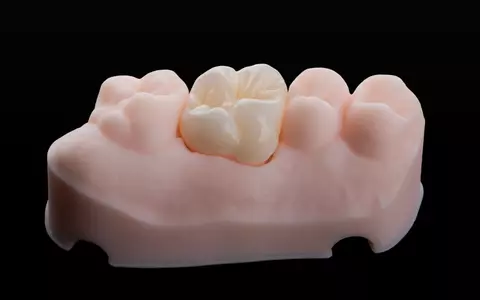 Când este momentul potrivit pentru a alege coroane dentare? 3 semne și indicații