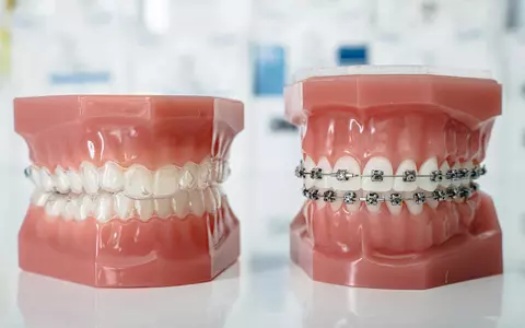 Cum îți poate schimba un aparat dentar încrederea în tine