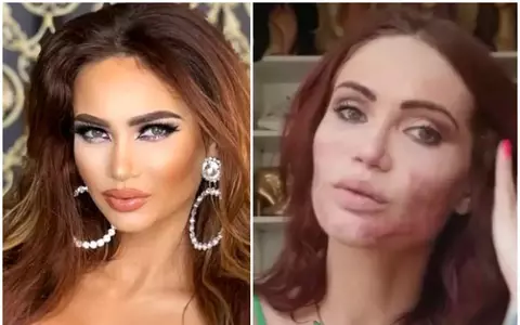 Maria Ilioiu de la Insula iubirii a pierdut procesul cu Valentin Burada și are de plătit 100.000 de euro: ”Voi face apel. Am rămas cu cicatrici pe față. Mi-a făcut o procedură un medic care nu avea dreptul să facă asta”/ EXCLUSIV