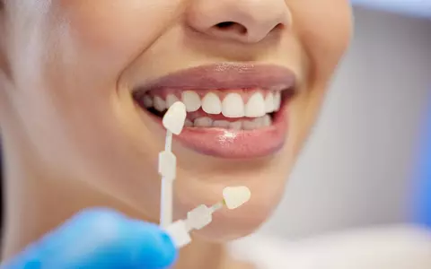 Fațetele dentare: estetică, preț și durabilitate