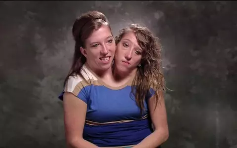 Gemenele siameze Abby și Brittany Hensel, care au corp comun, dar capete și inimi separate, au născut: "Binecuvântate!"/ Cine este tatăl copilului