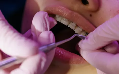 La ce costuri te poți aștepta anul acesta dacă ai nevoie de un tratament stomatologic cu aparat dentar