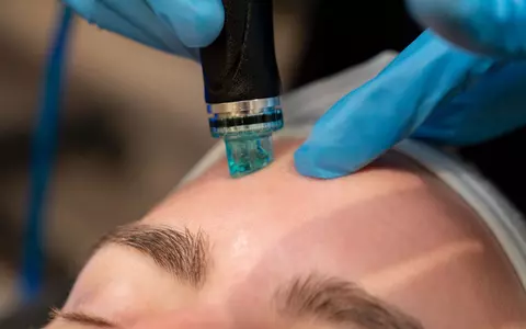 Top 4 beneficii ale Hydrafacial pentru tenul cu probleme