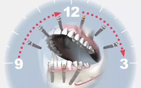 Implantul dentar în reabilitările complexe: opțiuni și etape de tratament
