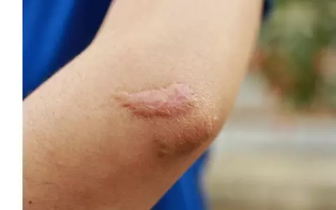 Cicatrici hipertrofice și cheloide: cauze, diferențe și opțiuni de tratament eficiente
