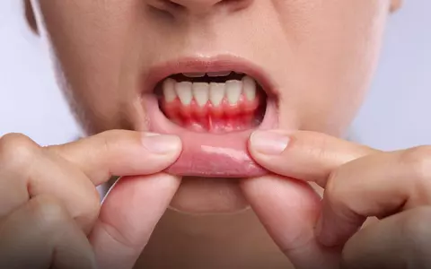 De ce sănătatea gingiilor merită tratată la fel de serios ca sănătatea dinților