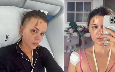 Emily Burghelea a răbufnit după ce Radu Ciucă a acuzat-o că și-a înscenat accidentul din Mauritius: "Am purtat săptămâni întregi o atelă metalică în cap și am petrecut o lună întreagă fără să îmi pot lua copiii în brațe"