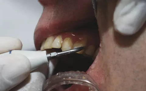 Medic stomatolog, avertisment despre curățarea tartrului acasă, prin metode virale pe TikTok. De ce e periculos: „Pot apărea afecțiuni!”