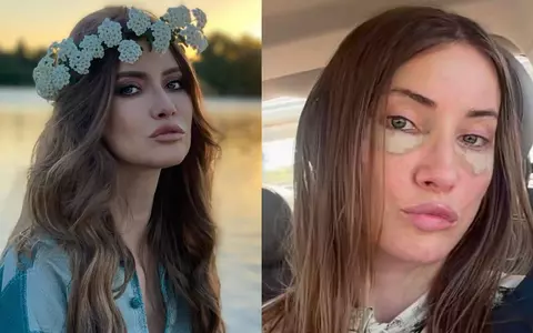 Iulia Albu și-a făcut lifting facial, la 44 de ani. Cum arată după operația estetică: „Procedura a reprezentat primul pas, urmat de un protocol de recuperare, perfuzii și tratamente”