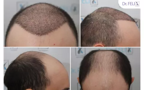 Implantul de păr în România, la Dr. Felix Hair Implant: bine de știut despre costuri și etapele procedurii