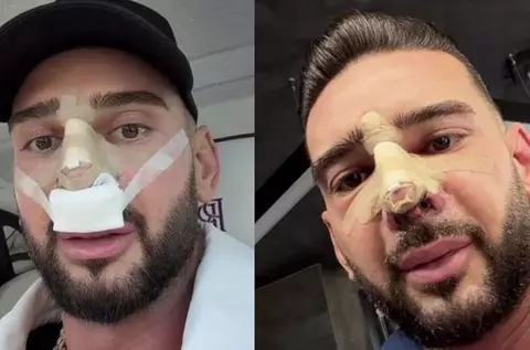 Cum arată nasul lui Dorian Popa la 12 zile de la operație. Și-a dat bandajul jos: „Cum nici nu am visat”