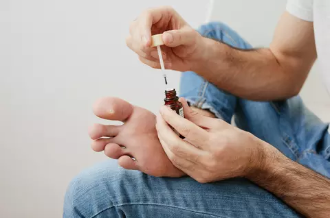 Bătătură în talpă – cum o previi și ce remedii să folosești