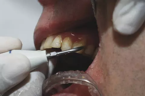 Medic stomatolog, avertisment despre curățarea tartrului acasă, prin metode virale pe TikTok. De ce e periculos: „Pot apărea afecțiuni!”