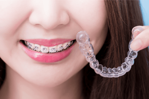 Îți dorești un zâmbet perfect? Ce tip de aparat dentar să alegi?