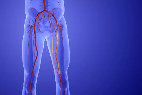 Boala arterială periferică: simptome și soluții chirurgicale moderne