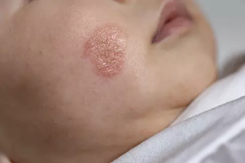 Infecțiile fungice ale pielii: diagnostic rapid în cabinetul de dermatologie