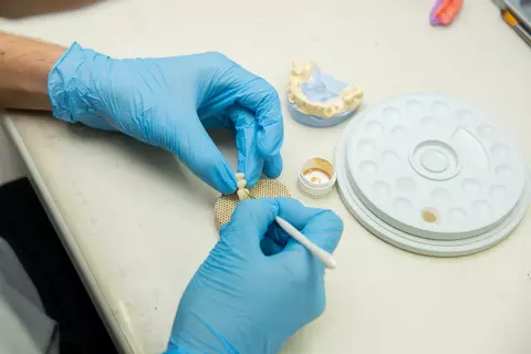 Este bruxismul o contraindicație a tratamentului cu implanturi dentare?