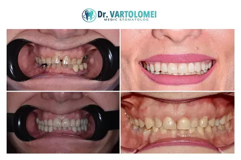 Zâmbet natural și estetica dentară responsabilă: ce trebuie să știi înainte de fațete dentare