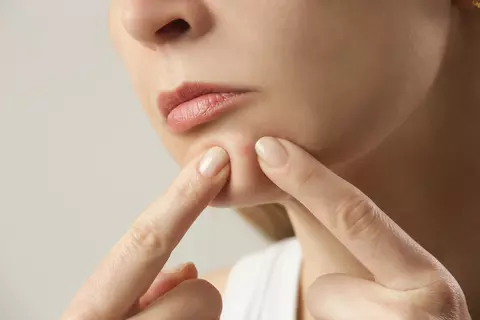 Acid glicolic vs acid azelaic pentru ten cu tendință acneică