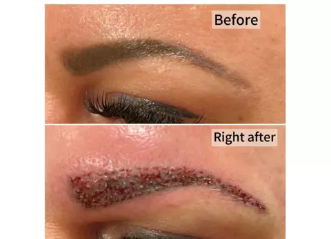 Transformă-ți înfățișarea cu un implant de păr și de sprâncene, pentru un look întinerit