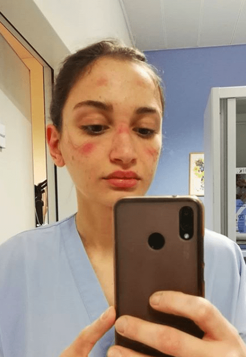 Imaginea suferinței! O asistentă din Italia și-a fotografiat chipul distrus de echipamentul de protecție și a transmis un mesaj cutremurător: „Mi-e frică să merg la muncă, dar...”