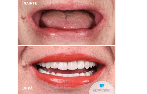 Ce presupune o coroană pe implant dentar: cum este abordat tratamentul la Dental Premier din București?
