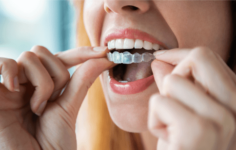 Fațete dentare sau aparat dentar: Alegerea corectă pentru o dantură perfectă