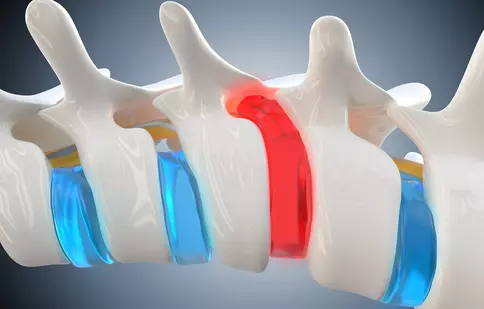 Cum să ameliorezi simptomele herniei de disc fără intervenție chirurgicală!